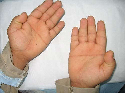 Mão de um portador de síndrome de  Down (Crédito: Reprodução)