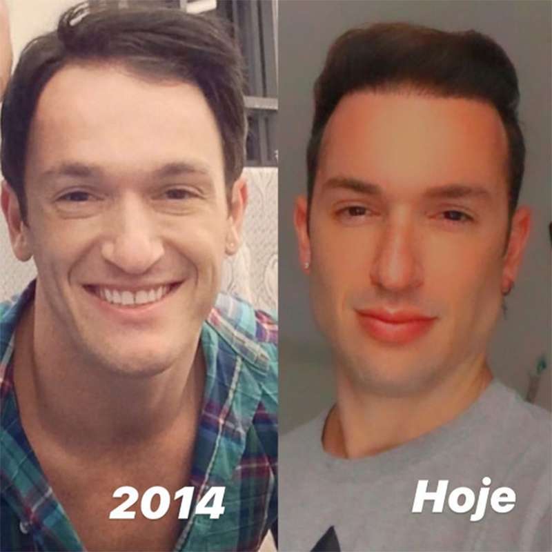 Veja o antes e depois de famosos que fizeram harmonização facial