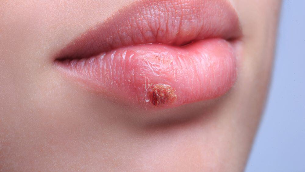 Herpes Labial O Que Causa Sintomas E Como Evitar Meionorte Hot Sex Picture