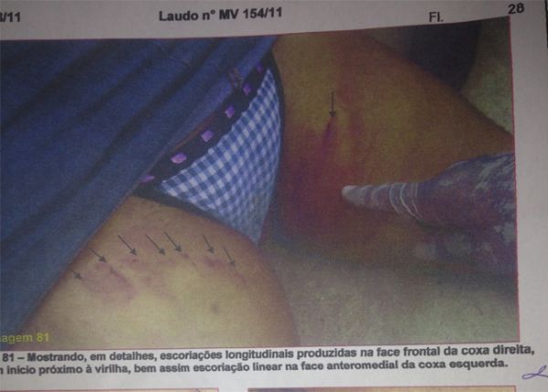 Caso Fernanda Lages: Lesões foram resultados de queda  - Imagem 4