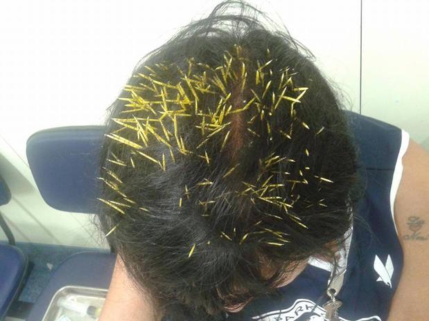 Mulher é atingida na cabeça por porco-espinho durante um passeio