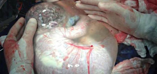 Extremamente raro: Médico registra o momento em que bebê nasce dentro de seu saco amniótico