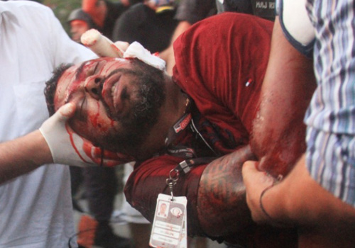 Cinegrafista da Band atingido em protesto está em estado grave