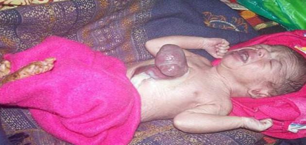 Bebê indiano nasce com seu coração fora do corpo e sobrevive