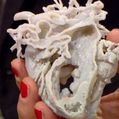 Coração reproduzido em 3D "salva" garotinha de dois anos