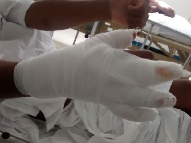 Garoto de 13 anos tenta fazer bomba com receita da internet e explosão queima mão e rosto