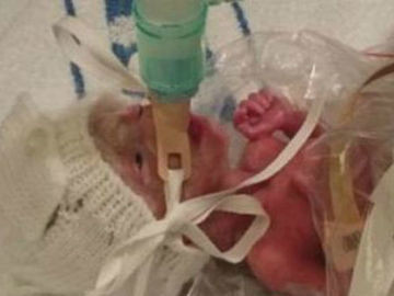 Medicos Usam Saco De Sanduiche Para Salvar Bebe Nascido Prematuro Meionorte Com