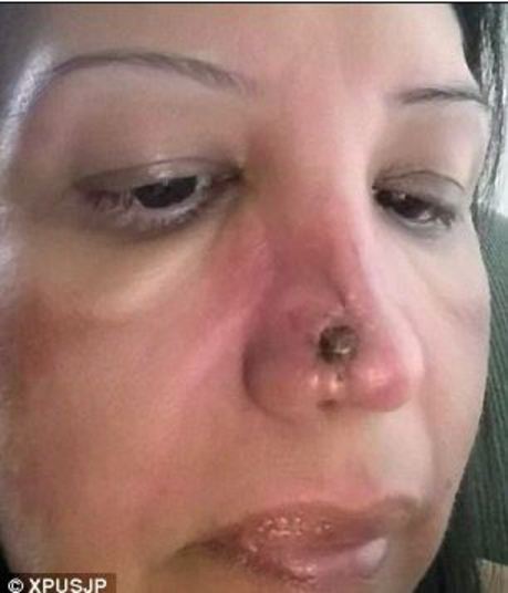 Médico erra na plástica e deixa buraco no nariz de mulher