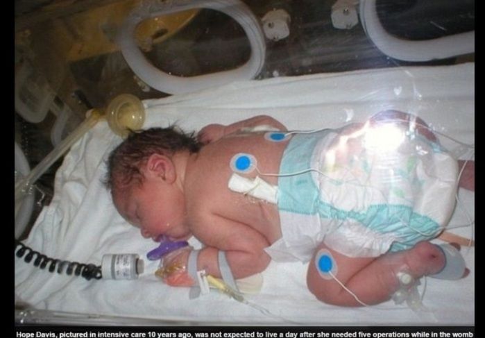 Bebê passou por cinco cirurgias (Crédito: Reprodução)