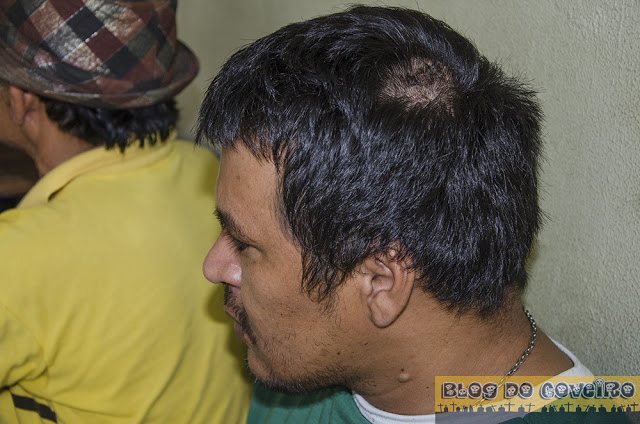 Eliomar Oliveira Moura mostrando os ferimentos (Crédito: Reprodução)
