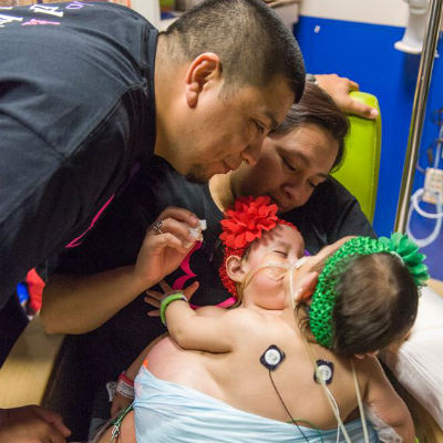 Siamesas são separadas em cirurgia com mais de um dia de duração
