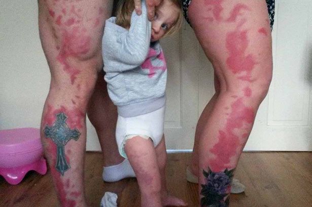 Pais fazem tatuagem para que filha que nasceu com manchas no corpo não se sentisse diferente