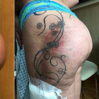 Cansada de sofrimento, Andressa Urach revela que queria retirar todo o bumbum