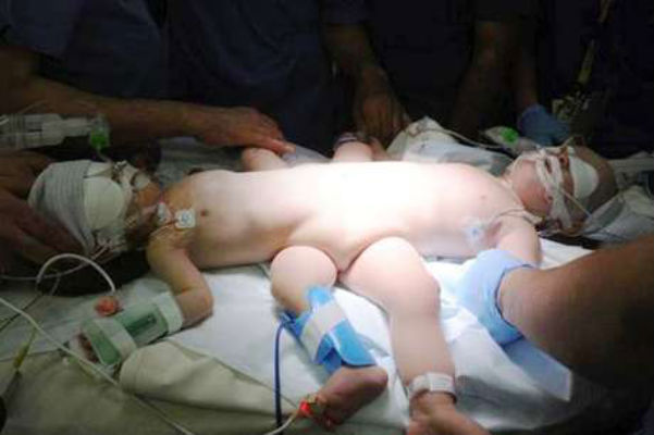 Cirurgia separa bebês siameses na Arábia Saudita