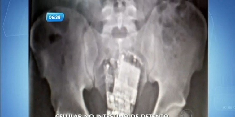Detento esconde dois celulares no ânus e vai parar no hospital