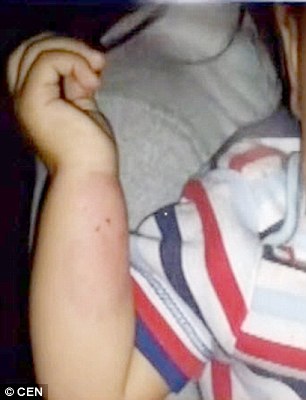 Criança com marcas da agressão (Crédito: Reprodução)