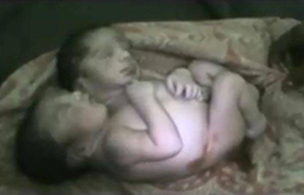 Bebê com duas cabeças (Crédito: Divulgação )
