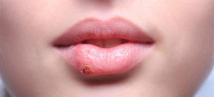 Mais de metade da população mundial tem herpes labial