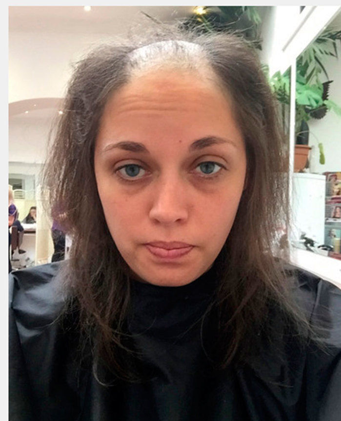 Ela chegou a ficar careca, apenas tirando seus fios de cabelo (Crédito: The Sun )