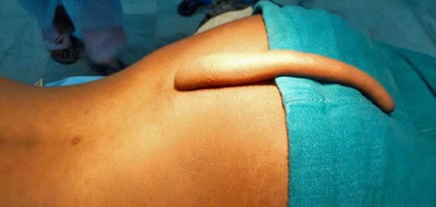 Jovem remove cauda de 20 cm aos 18 anos