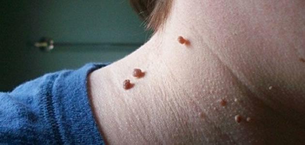 Saiba como acabar com as verrugas com receita caseira