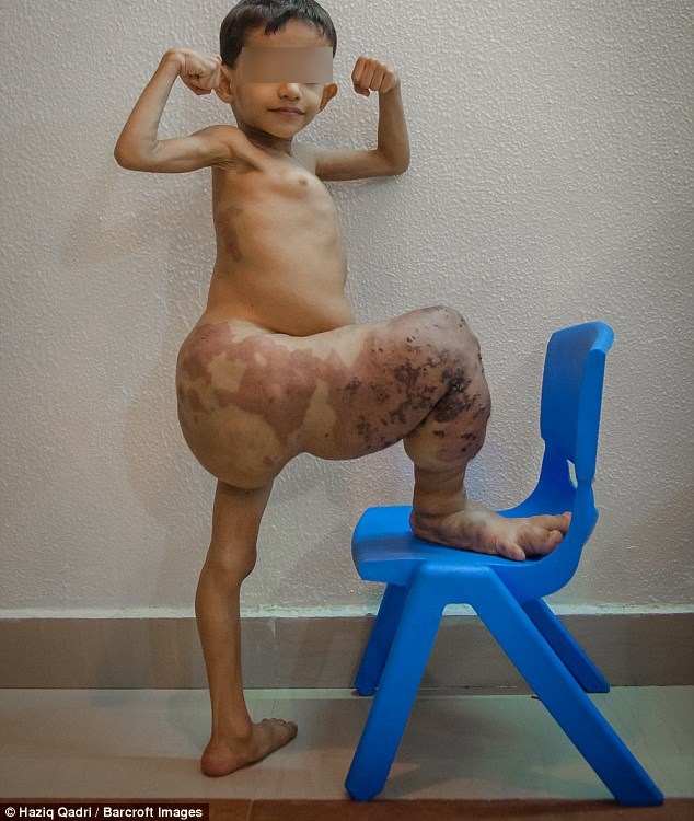 Menino possui sínddrome rara