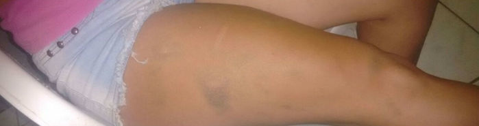 Jovem apresentava vários hematomas pelo corpo (Crédito: Divulgação)