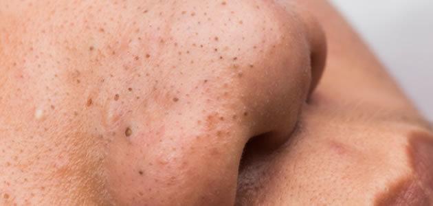 5 maneiras de evitar pontinhos pretos no rosto