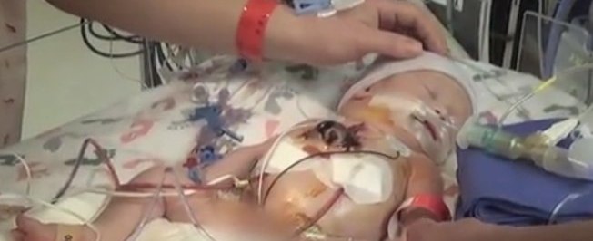 Bebê que nasceu com coração para fora do peito passa bem