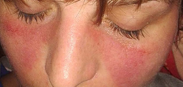 9 coisas que você não sabia sobre o lúpus