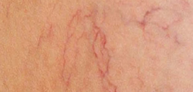 Dicas caseiras de como acabar com as varizes