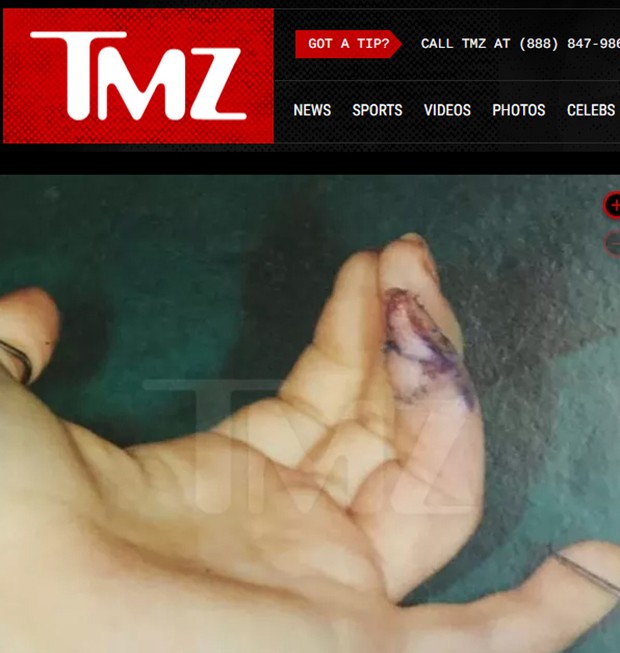 Dedo decepado de Lindsay Lohan