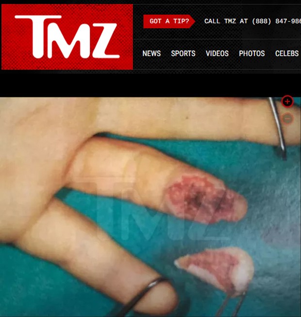Dedo decepado de Lindsay Lohan