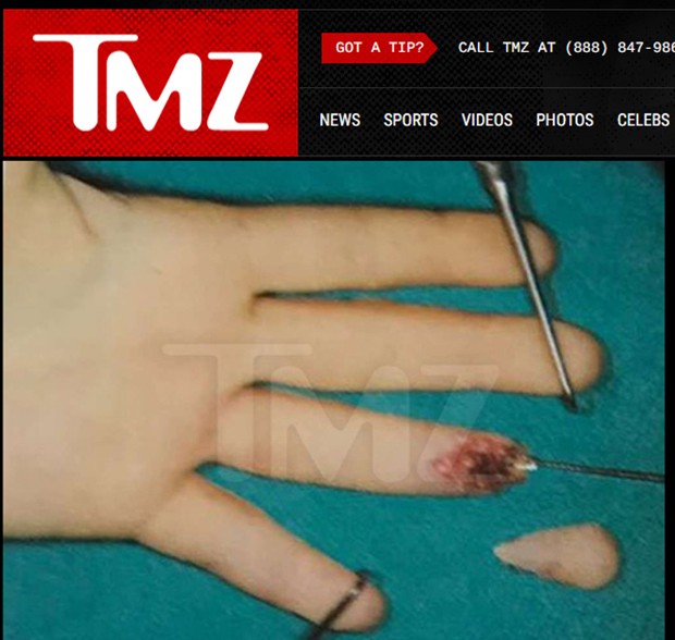 Dedo decepado de Lindsay Lohan