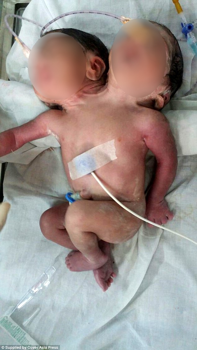 Bebê nasce com duas cabeças na Índia