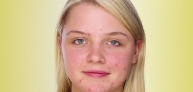 Pessoas com acne possuem menos rugas ao envelhecer