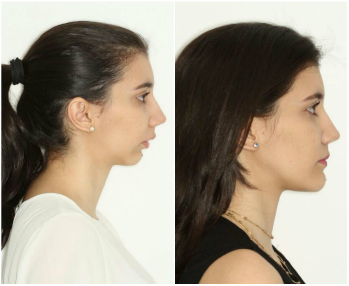Cirurgia ortognática faz correção e melhora estética da face