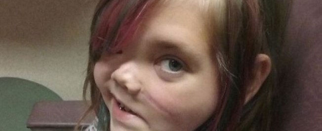 Menina que teve crânio partido ao meio reage após anos em coma