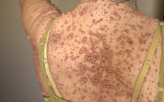 Libby Huffer tem mais de 5,5 mil tumores pelo corpo