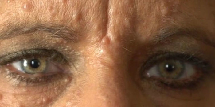 Devido doença, mulher tem mais de 5,5 mil tumores pelo corpo