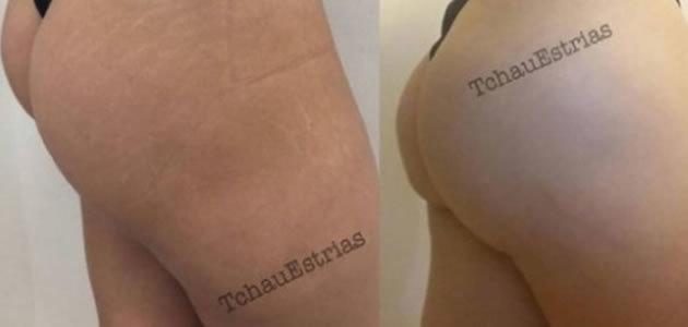 Tatuador fica famoso ao camuflar estrias