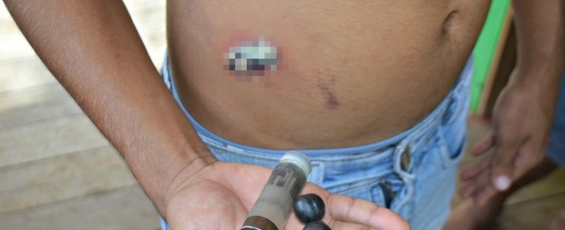 Menino de 3 anos é atingido por balas de borracha no Acre
