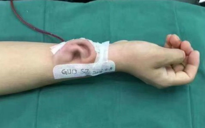 Chinês teve orelha implantada no braço
