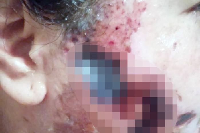 Mulher fica com rosto em carne viva ao ser atacada com ácido por ex