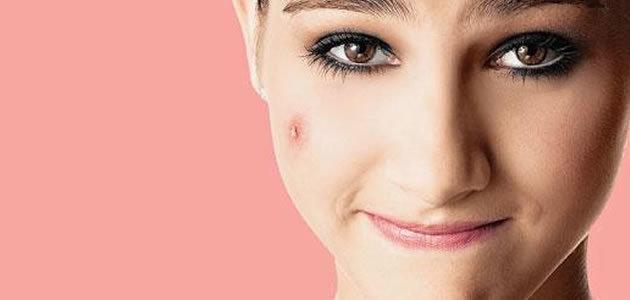 Coisas que você precisa saber sobre a acne