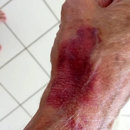 Idoso exibe marcas de hematomas (Crédito: Reprodução)