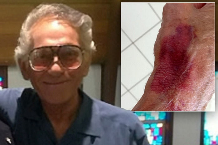 Idoso exibe marcas de hematomas (Crédito: Reprodução)