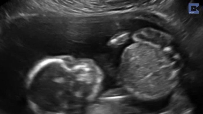 Bebê se soca em ultrassom (Crédito: Reprodução)