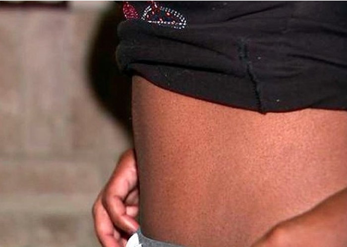 Mulher ficou sem umbigo após cirurgia