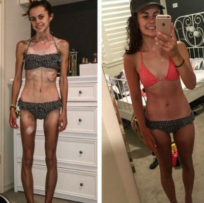 A jovem chegou a pesar 25Kg (Crédito: Reprodução)